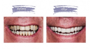 teeth-replacement-1f0e3dad99908345f7439f8ffabdffc4.jpg