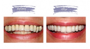 teeth-replacement-6f4922f45568161a8cdf4ad2299f6d23.jpg