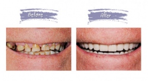 teeth-replacement-70efdf2ec9b086079795c442636b55fb.jpg