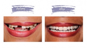 teeth-replacement-98f13708210194c475687be6106a3b84.jpg