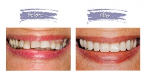 teeth-replacement-9bf31c7ff062936a96d3c8bd1f8f2ff3.jpg