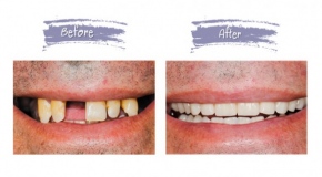 teeth-replacement-c74d97b01eae257e44aa9d5bade97baf.jpg